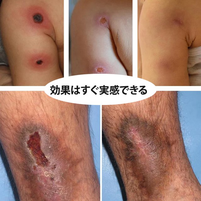 血糖ケアブレスレット